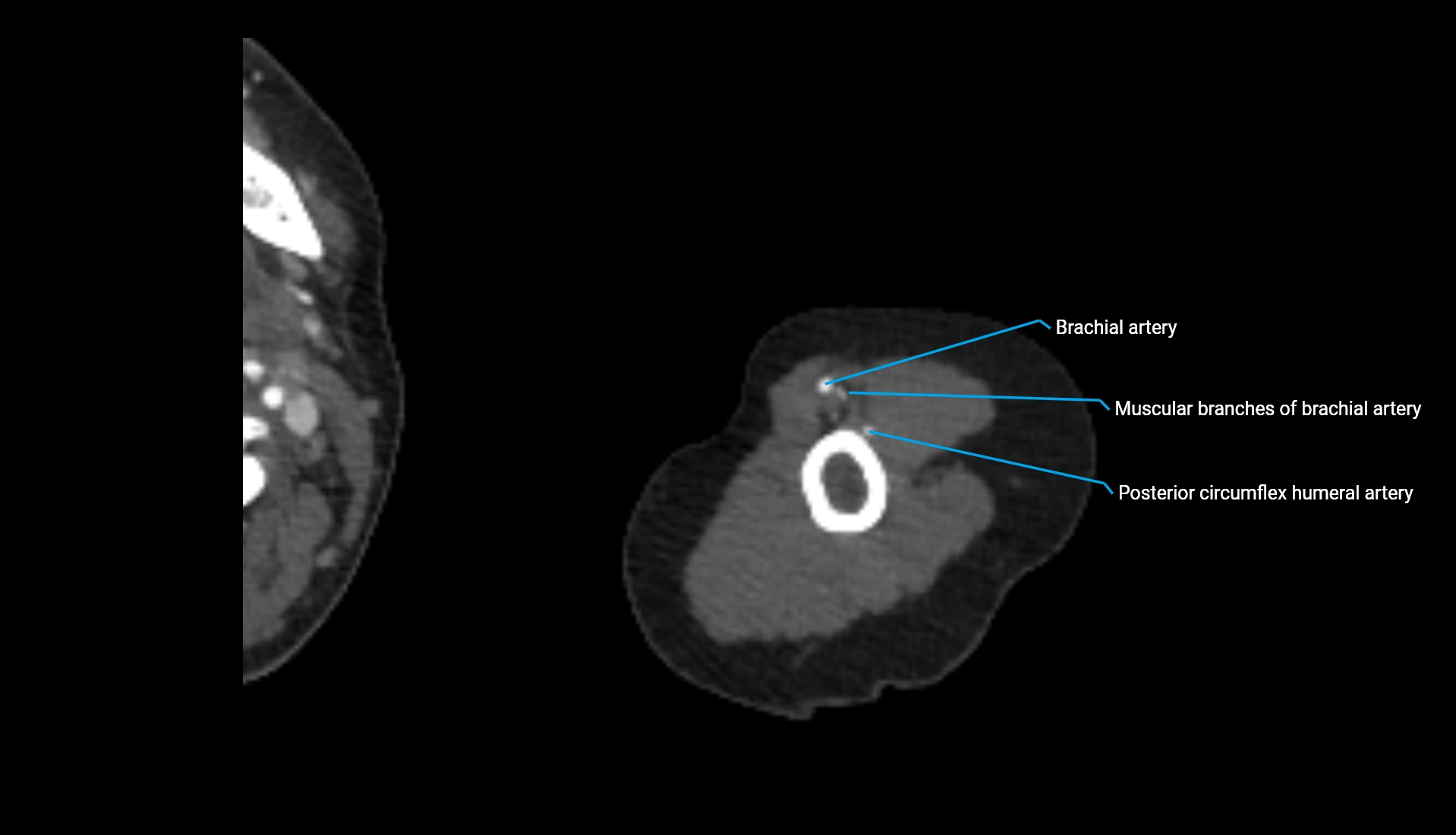 CTA upper limb axial cross sectional anatomy labelled image 293 (2).webp